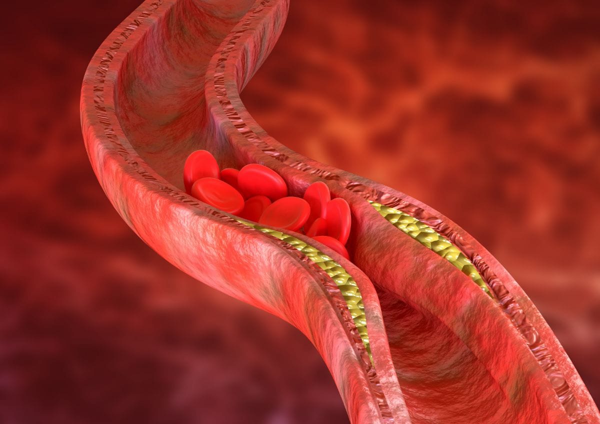 imagem conceito de doença cardiovascular