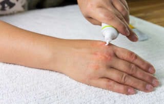 aplicando pomada e creme emoliente no tratamento de dermatite